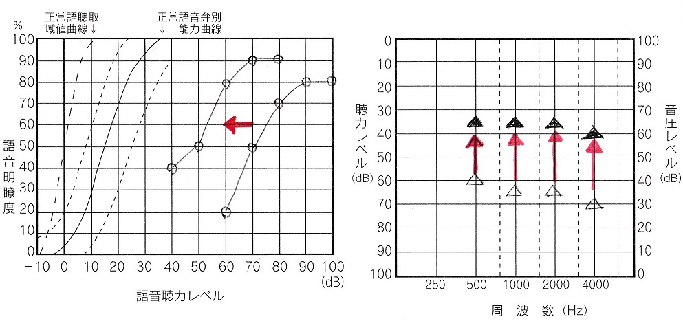 聞こえの評価