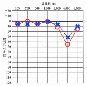 騒音性難聴について